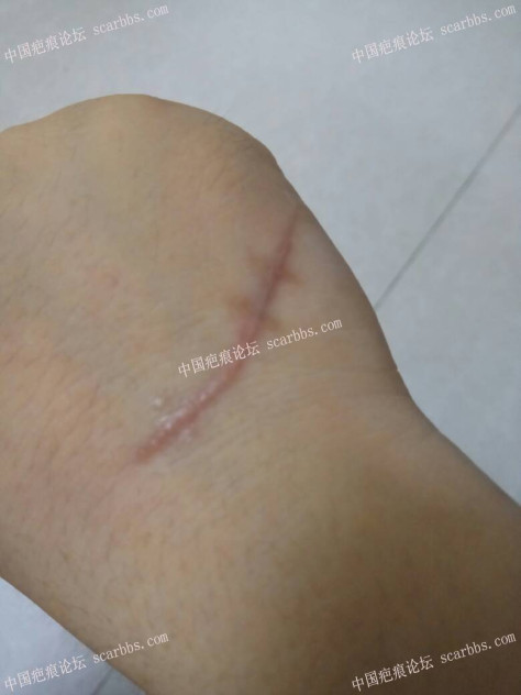 疤痕切缝术后常需要一个漫长的恢复期 