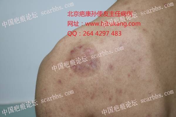 疤康治疗结束2年的瘢痕疙瘩未复发 背部疤痕疙瘩,北京疤康