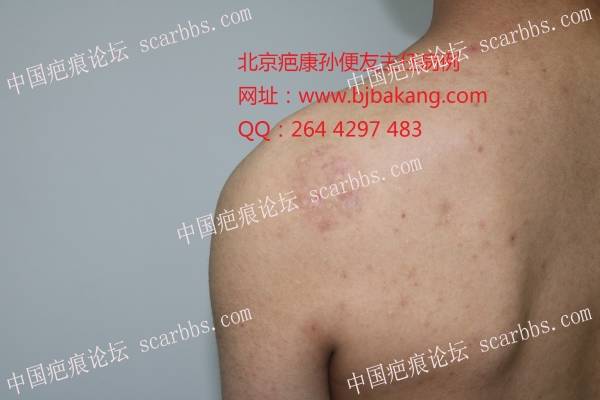 疤康治疗结束2年的瘢痕疙瘩未复发 背部疤痕疙瘩,北京疤康