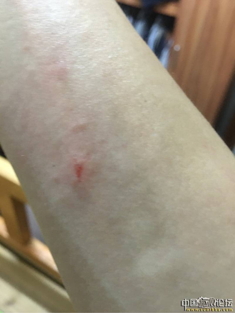 手腕疤痕八个月了怎么比六个月严重 