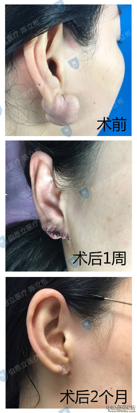 耳部疤痕疙瘩治疗术后2个月反馈 疤痕