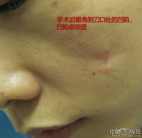 面部凹陷疤痕切除手术3个月后情况不好 