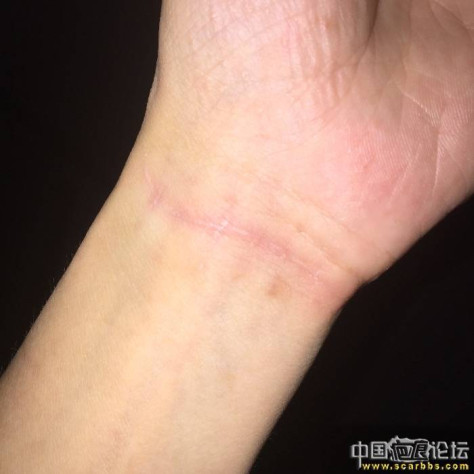 手腕疤痕八个月了怎么比六个月严重 
