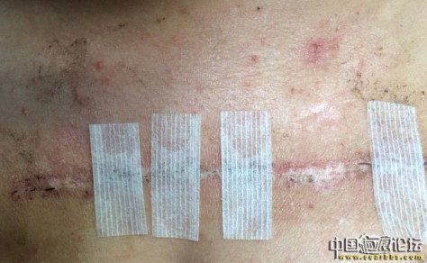 胸口疤痕疙瘩十年之久终于去除了 胸口疤痕疙瘩,手术治疗,放疗