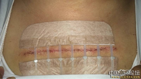 胸口疤痕疙瘩十年之久终于去除了 胸口疤痕疙瘩,手术治疗,放疗