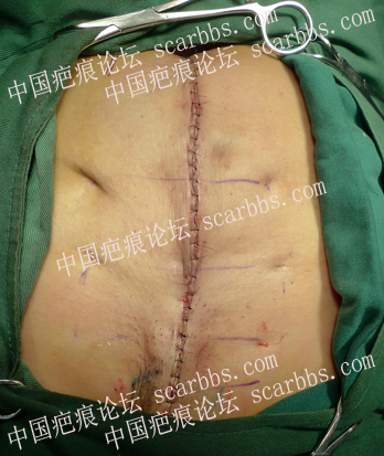 一例严重剖腹产疤痕的手术治疗（术后未放疗） 剖腹产疤痕,挛缩明显,反复溃破,病灶切除术