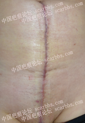 一例严重剖腹产疤痕的手术治疗（术后未放疗） 剖腹产疤痕,挛缩明显,反复溃破,病灶切除术