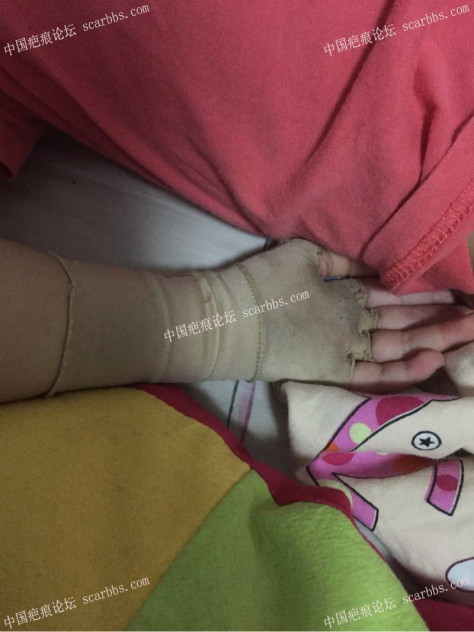 宝宝烧伤，抗疤7个月，初见希望！ 