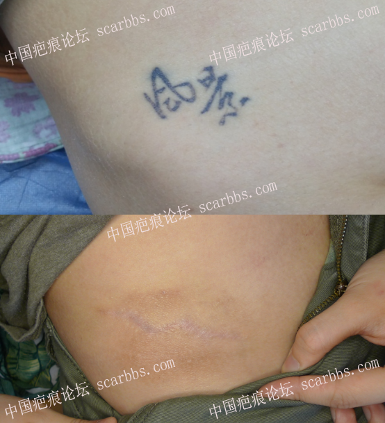 纹身切除术效果展示及建议 纹身疤痕,纹身疤痕手术切除