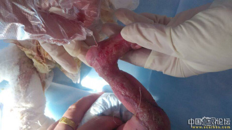 李高令2015年接治第一例新生儿先天性皮肤缺损孩子(湖北) 