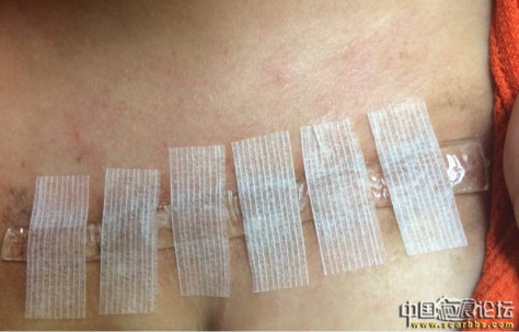 九院武晓莉，胸前疤痕疙瘩手术后一个月零十天了！ 