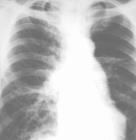 矽肺病跟肺气肿有什么区别