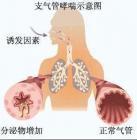小儿支气管哮喘的护理方法