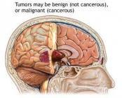 脑胶质瘤是如何产生的?